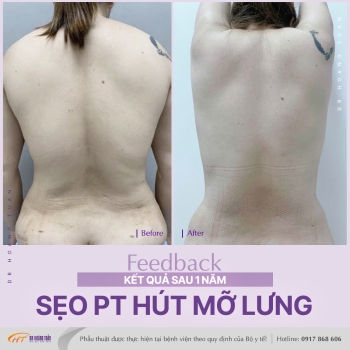 HÚT MỠ