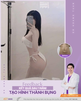 HÚT MỠ