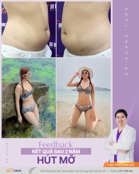 HÚT MỠ
