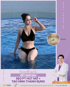 HÚT MỠ