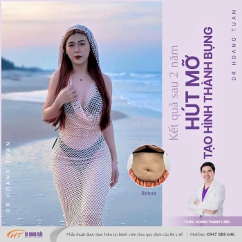 HÚT MỠ