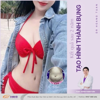 HÚT MỠ