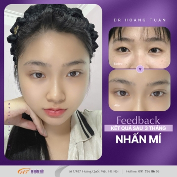 THẨM MỸ MẮT