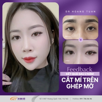 THẨM MỸ MẮT