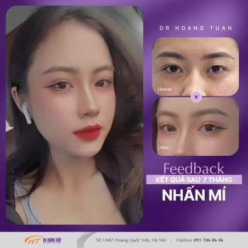 THẨM MỸ MẮT