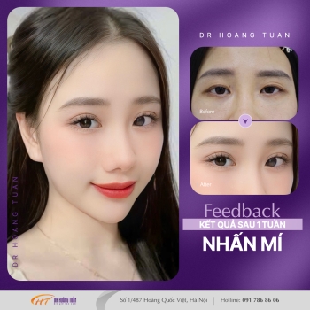 THẨM MỸ MẮT