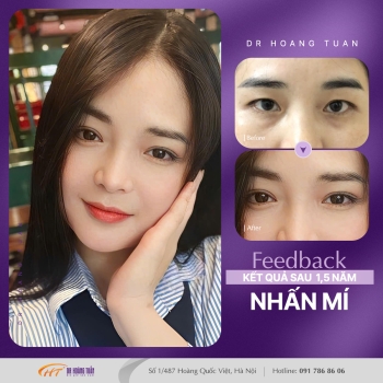 THẨM MỸ MẮT