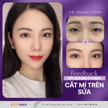THẨM MỸ MẮT