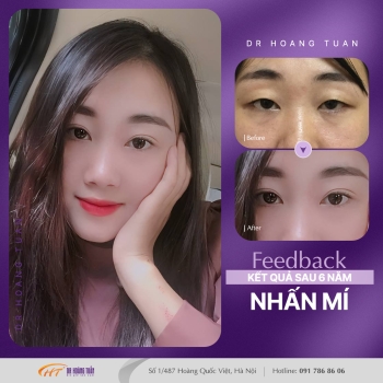 THẨM MỸ MẮT