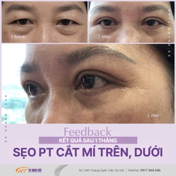 THẨM MỸ MẮT