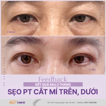 THẨM MỸ MẮT