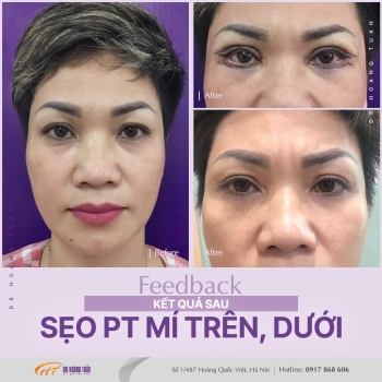 THẨM MỸ MẮT