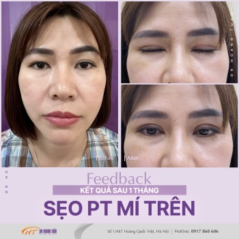 THẨM MỸ MẮT
