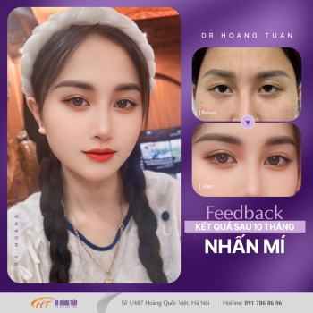 THẨM MỸ MẮT