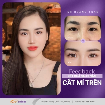 THẨM MỸ MẮT