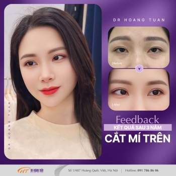 THẨM MỸ MẮT