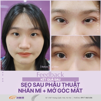 THẨM MỸ MẮT