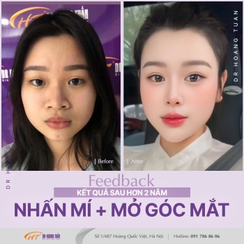 THẨM MỸ MẮT