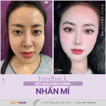 THẨM MỸ MẮT
