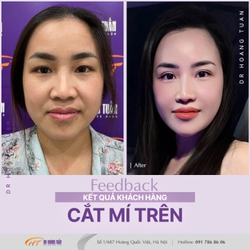 THẨM MỸ MẮT
