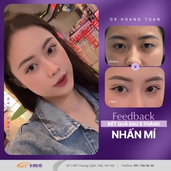 THẨM MỸ MẮT