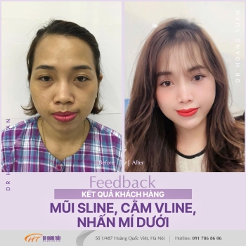 THẨM MỸ MŨI
