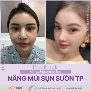 THẨM MỸ MŨI