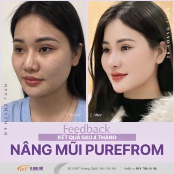 THẨM MỸ MŨI