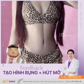 TẠO HÌNH THÀNH BỤNG
