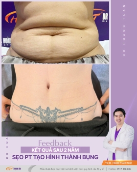 TẠO HÌNH THÀNH BỤNG