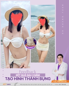 TẠO HÌNH THÀNH BỤNG