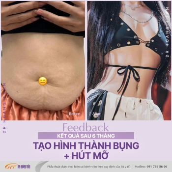 TẠO HÌNH THÀNH BỤNG