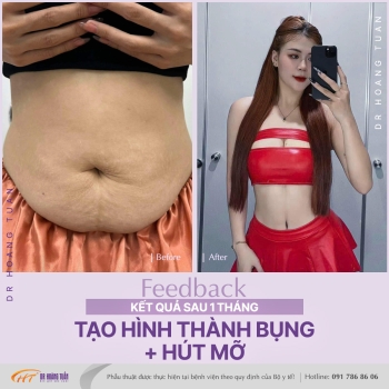 TẠO HÌNH THÀNH BỤNG