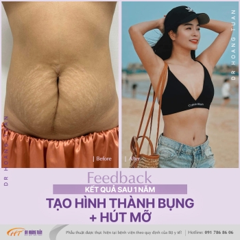 TẠO HÌNH THÀNH BỤNG