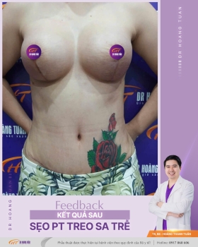 TREO SA TRỄ