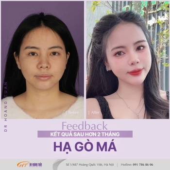 XƯƠNG HÀM MẶT