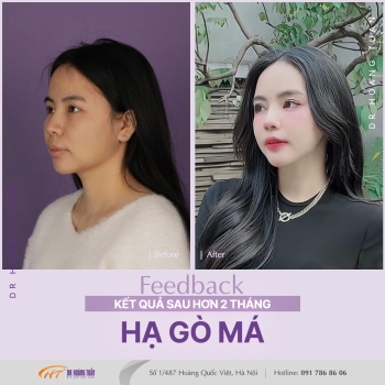 XƯƠNG HÀM MẶT
