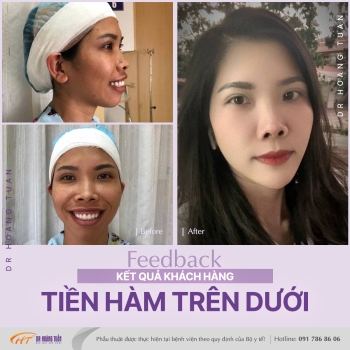 XƯƠNG HÀM MẶT