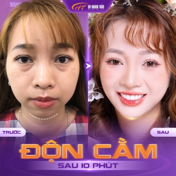 Độn cằm có để lại sẹo không? Khám phá kỹ thuật “giấu sẹo” trong thẩm mỹ hiện đại