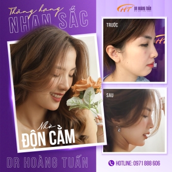 Độn cằm có đau không? Bật mí trải nghiệm thật của những người đã từng độn cằm