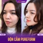 Độn cằm rồi có tiêm filler được không? Khi nào có thể tiêm?