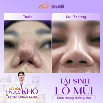 MŨI SỬA MŨI KHÓ CÓ DR HOÀNG TUẤN LO