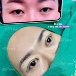 Cắt mí làm sao cho nhanh hết sưng? Bác sĩ Dr Hoàng Tuấn giải đáp chi tiết