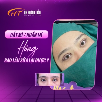 Cắt mí rồi có cắt lại được không? Những điều cần biết trước khi sửa mí