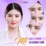 Cắt mí 1 tháng vẫn sưng thì phải làm sao?