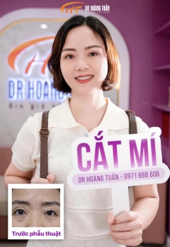 Cắt mí sau bao lâu thì nối mi được để không ảnh hưởng đến vết thương?