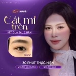 Cắt mí bao lâu thì tự nhiên? Cách rút ngắn thời gian hồi phục