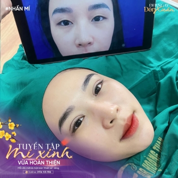 Cắt mí có giữ được vĩnh viễn không? Câu trả lời khiến nhiều người bất ngờ