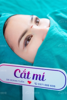 Cắt mí có làm ảnh hưởng đến thị lực không? Những điều cần biết trước khi làm