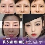 Cắt mí quá sâu khiến mắt trợn? Nguyên nhân và cách khắc phục